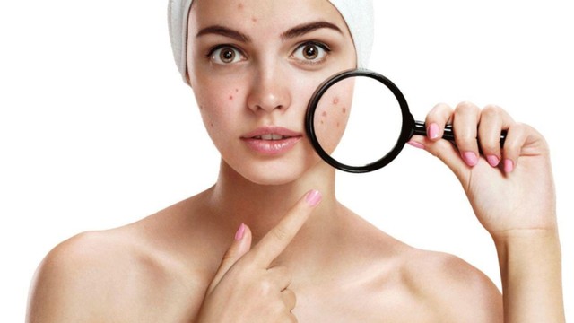 Uống kẽm trị mụn nội tiết có hiệu quả không? Cách dùng đúng và lưu ý quan trọng