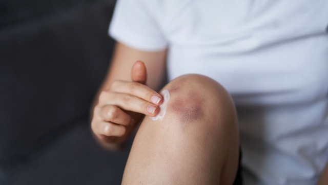 Vết bầm tím trên da không rõ nguyên nhân: Cảnh báo về sức khỏe bạn nên biết