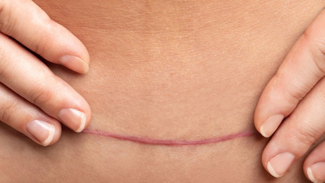 Vết mổ sau sinh bị đỏ: Dấu hiệu bình thường hay cảnh báo biến chứng nguy hiểm?