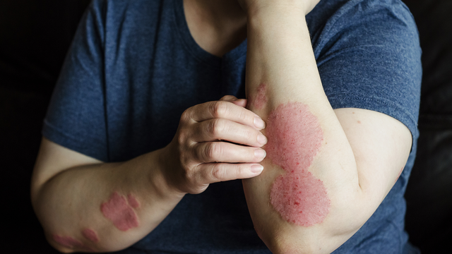 Nguyên nhân xuất hiện vết tròn bị nổi đốm đỏ trên da và ngứa​