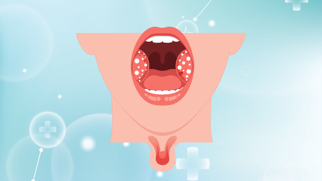 Viêm amidan hốc mủ 1 bên: Dấu hiệu nhận biết, nguyên nhân và cách điều trị