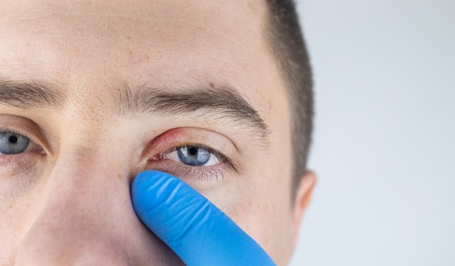 Viêm bờ mi mắt trên là gì? Dấu hiệu nhận biết và cách phòng bệnh