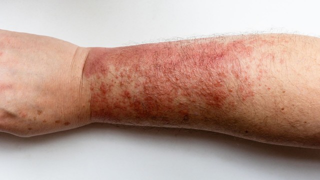 Viêm da liên cầu: Nguyên nhân, triệu chứng và cách điều trị