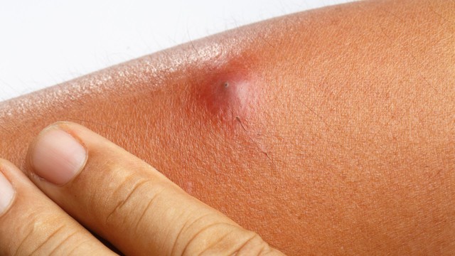 Viêm da mủ là gì? Những điều cần biết về viêm da mủ