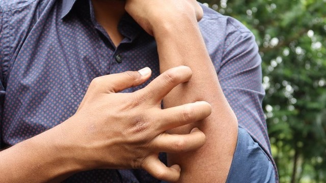 Viêm da tiếp xúc dị ứng là gì? Nguyên nhân, triệu chứng, điều trị