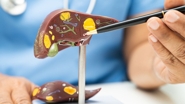 Viêm gan ứ sắt là gì? Nguyên nhân, dấu hiệu và cách phòng ngừa