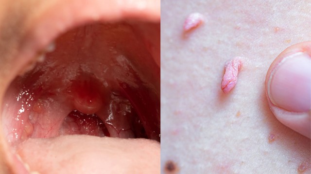 Viêm họng hạt và sùi mào gà: Phân biệt, điều trị và phòng ngừa hiệu quả