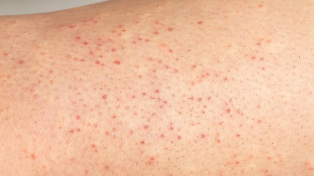 Viêm lỗ chân lông ở chân: Nguyên nhân và cách điều trị hiệu quả