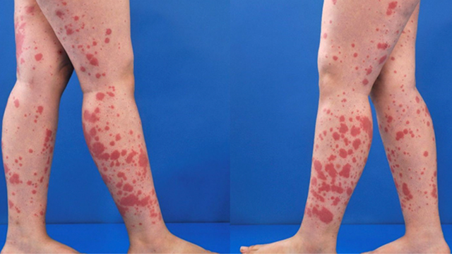 Viêm mao mạch dị ứng bao lâu thì khỏi? Điều trị bệnh như thế nào?