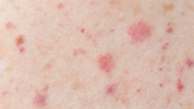 Viêm mao mạch dị ứng có chữa được không? 