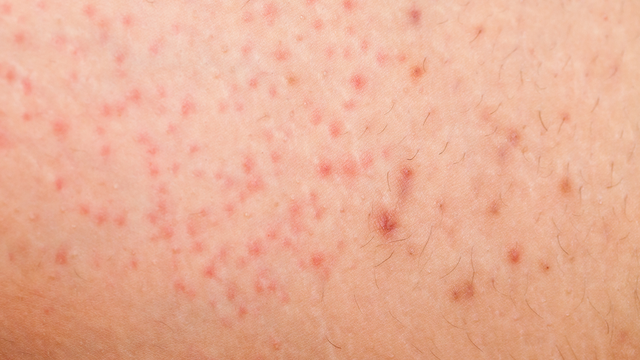 Viêm nang lông: Triệu chứng, nguyên nhân, chẩn đoán và điều trị