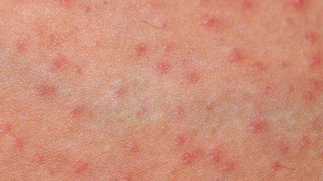 Viêm nang lông do nấm Malassezia: Dấu hiệu, nguyên nhân và cách điều trị