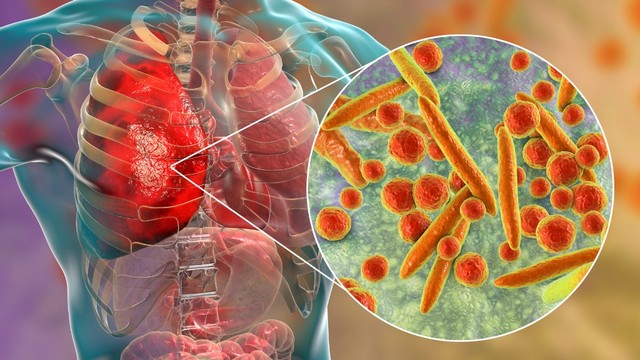 Viêm phổi do bội nhiễm là gì? Nguyên nhân, dấu hiệu và cách phòng ngừa