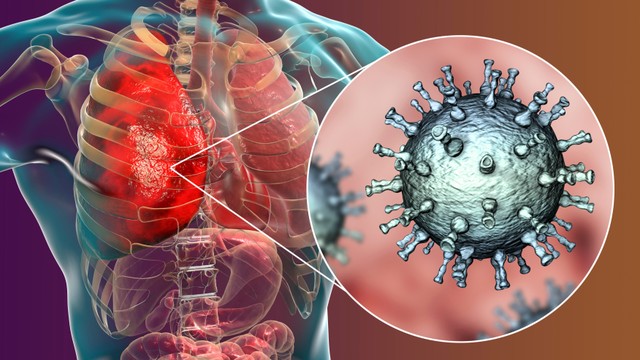 Viêm phổi do virus là gì? Triệu chứng, nguy cơ, chẩn đoán và điều trị bệnh