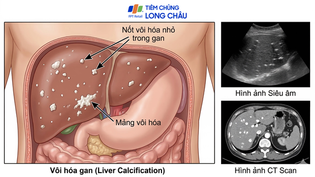 Vôi hoá gan là gì? Nguyên nhân, dấu hiệu và khi nào cần theo dõi sức khỏe gan
