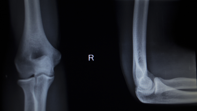 X-quang khớp khuỷu: Khi nào cần chụp, phát hiện gì và những điều cần biết