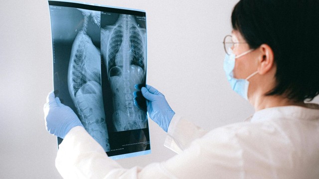 X-quang viêm phế quản: Cách chẩn đoán hình ảnh giúp phát hiện bệnh chính xác
