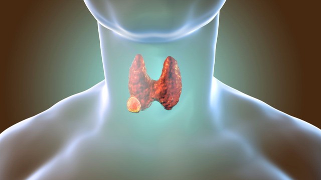 Xạ trị ung thư tuyến giáp là gì? Những điều cần biết trước khi điều trị
