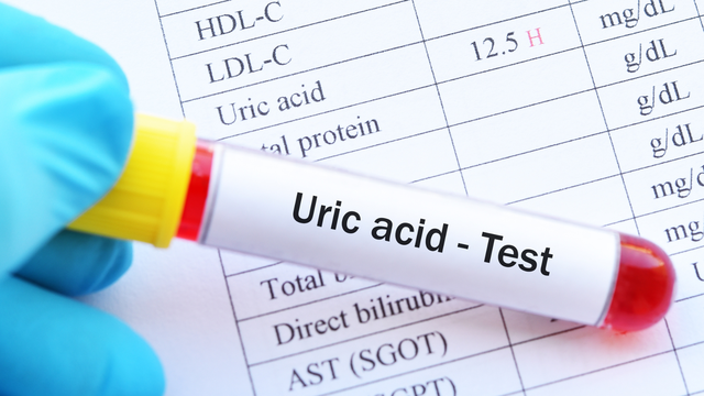 Xét nghiệm acid uric là gì? Khi nào nên làm xét nghiệm acid uric? 