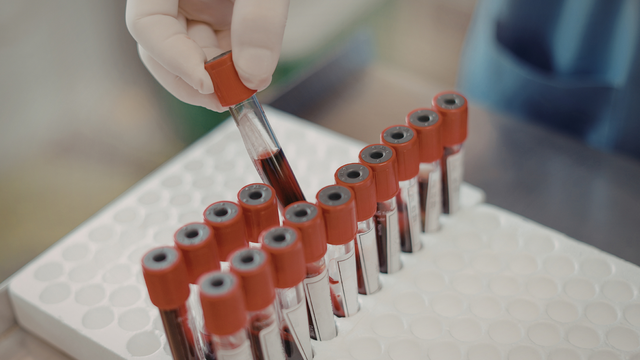 Xét nghiệm canxi máu bao nhiêu tiền? Khi nào cần thực hiện?