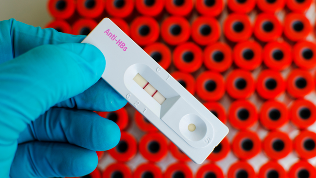 Xét nghiệm HBsAb: Ý nghĩa và quy trình cần biết