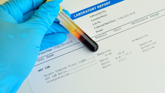 Xét nghiệm HSV bao nhiêu tiền? Các phương pháp xét nghiệm HSV