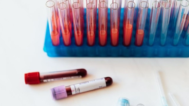 Xét nghiệm mỡ máu có cần nhịn ăn không? Các yếu tố ảnh hưởng kết quả xét nghiệm