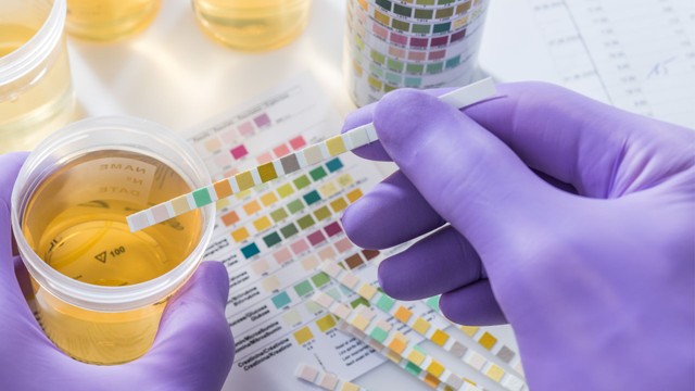 Xét nghiệm nước tiểu bao lâu có kết quả? Thời gian trả kết quả theo từng loại xét nghiệm