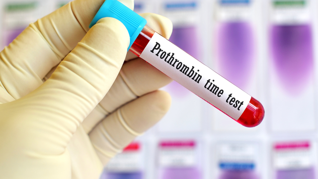 Xét nghiệm PT là gì? Khi nào nên thực hiện xét nghiệm?