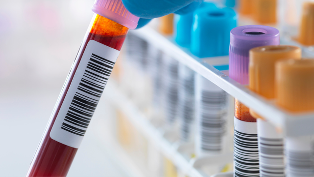 Xét nghiệm RPR giang mai là gì? Chỉ định, quy trình và ý nghĩa kết quả