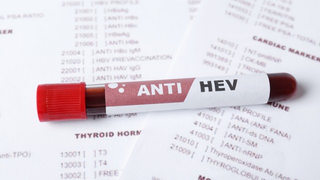 Xét nghiệm viêm gan E: Những điều cần biết trước khi thực hiện