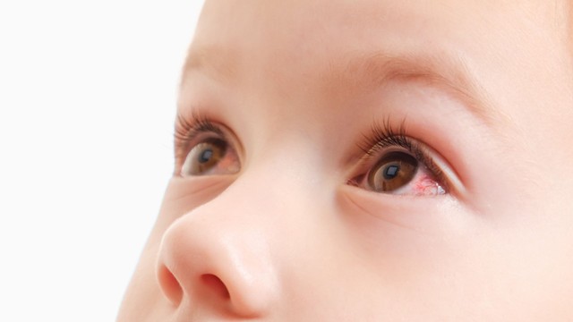 Xuất huyết mắt là gì? Nguyên nhân, dấu hiệu và cách xử lý