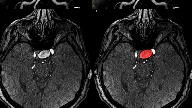 Xuất huyết não sống được bao lâu? Tiên lượng, yếu tố ảnh hưởng và cách phục hồi