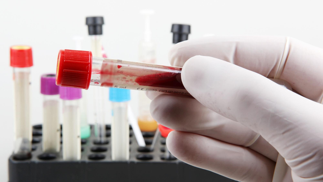 Ý nghĩa kết quả xét nghiệm viêm khớp dạng thấp là gì?