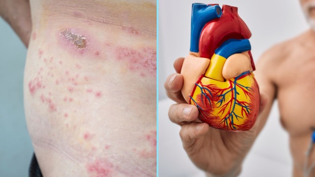 Zona thần kinh ở người bệnh tim mạch có nguy hiểm không? Biện pháp phòng bệnh hiệu quả