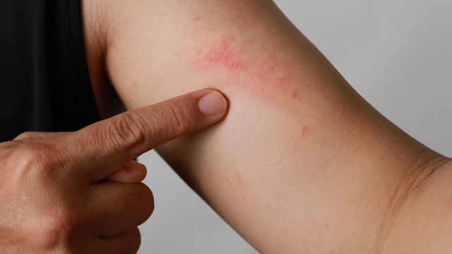Hình ảnh sán chó trên da và dấu hiệu nhận biết ngứa da do sán chó