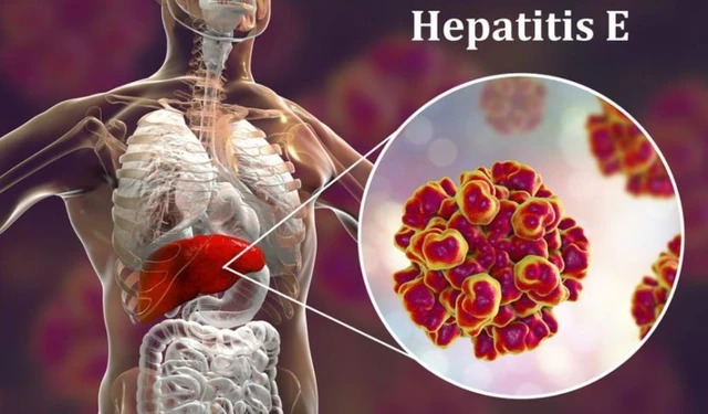 Viêm gan E có lây không? Đường lây truyền virus viêm gan E cần biết