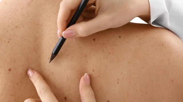 Vì sao trẻ bị nổi đốm nâu trên da? Cách xử lý tình trạng này như thế nào?