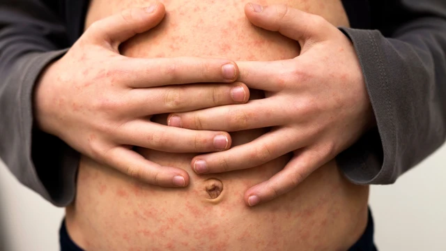 Bà bầu bị sởi phải làm sao? Cách xử trí như thế nào?