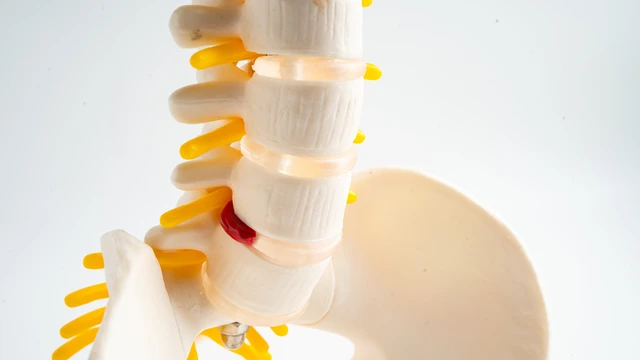 Các bài tập cho phồng đĩa đệm tại nhà và những lưu ý cần biết