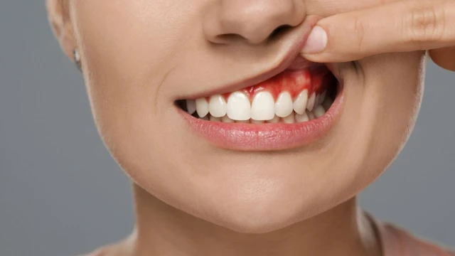 Bật mí những cách chữa viêm lợi tại nhà nhanh nhất không phải ai cũng biết