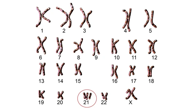 Bất thường nhiễm sắc thể 21 là bệnh gì? Có nguy hiểm không?