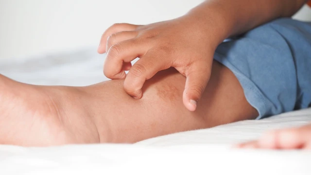 Bé bị ngứa về đêm: Nguyên nhân thường gặp và cách giúp con ngủ ngon hơn
