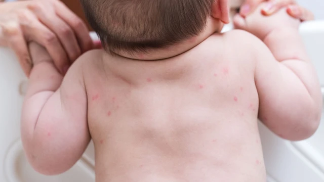 Bé bị nổi mẩn đỏ khắp người không sốt không ngứa có nguy hiểm không?
