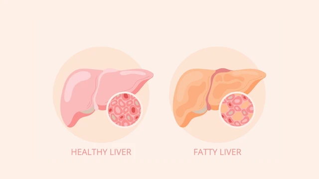 Gan nhiễm mỡ: Dấu hiệu, nguyên nhân, phương pháp chẩn đoán, điều trị và phòng ngừa