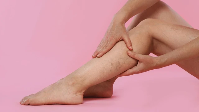 Giãn tĩnh mạch chi dưới: Nguyên nhân, triệu chứng và điều trị