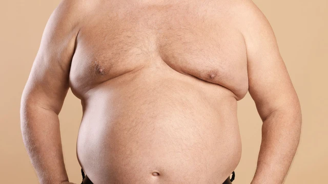Bệnh Gynecomastia là gì? Những điều cần biết về bệnh Gynecomastia
