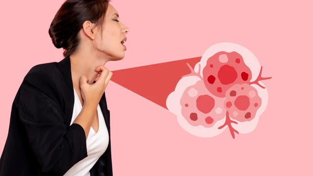 Hạt xơ thanh quản​ là gì? Triệu chứng, nguyên nhân và cách điều trị