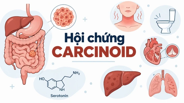 benh_a_z_hoi_chung_carcinoid_1_2dd253beb5