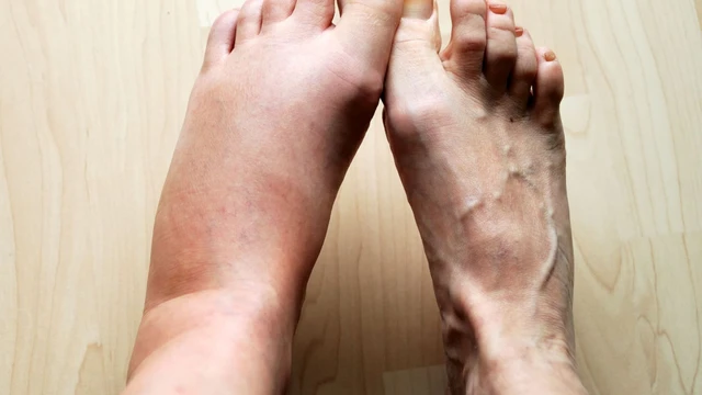 Hội chứng May Thurner là gì? Nguyên nhân, triệu chứng và cách điều trị